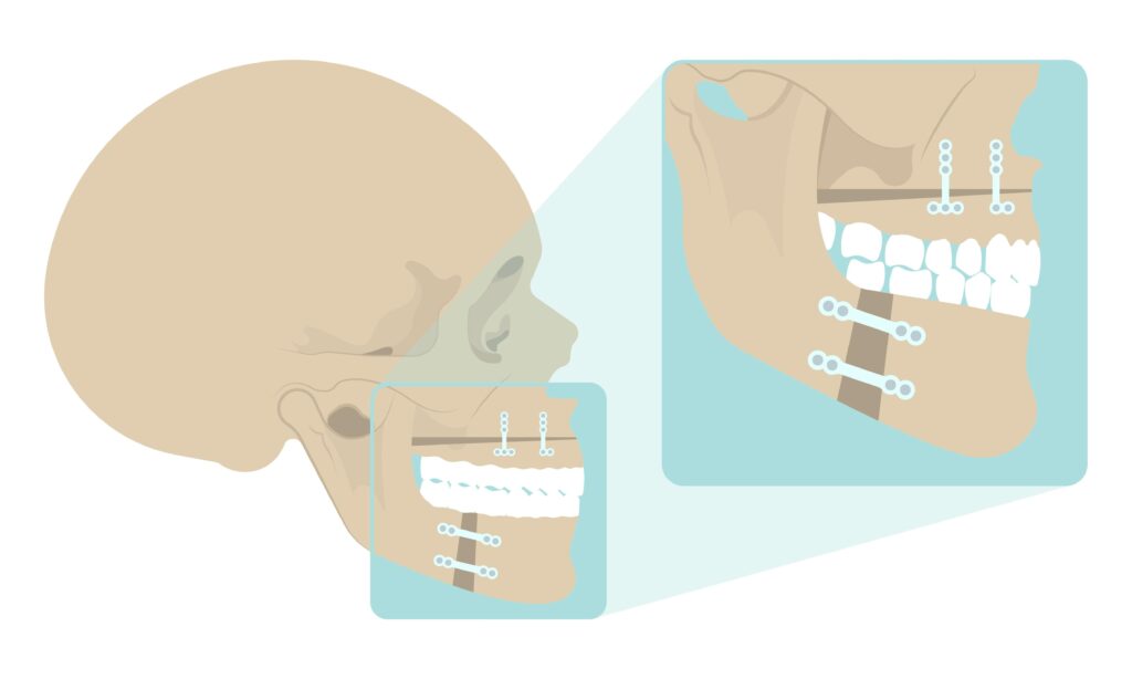 Ilustração do prognatismo e retrognatismo da Cirurgia Ortognática